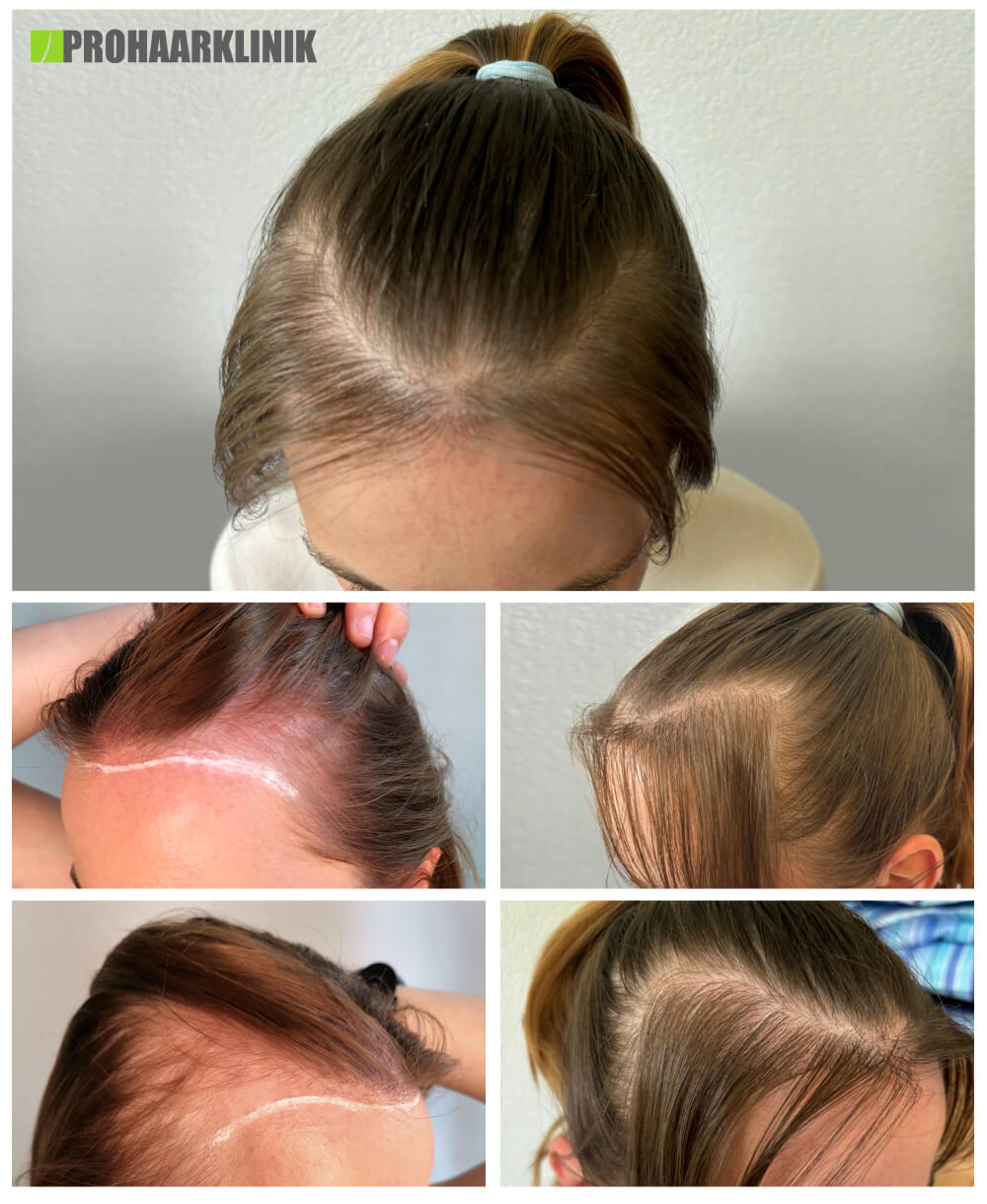Haartransplantation vorher-nachher: Ivana - PROHAARKLINIK nahe Wien