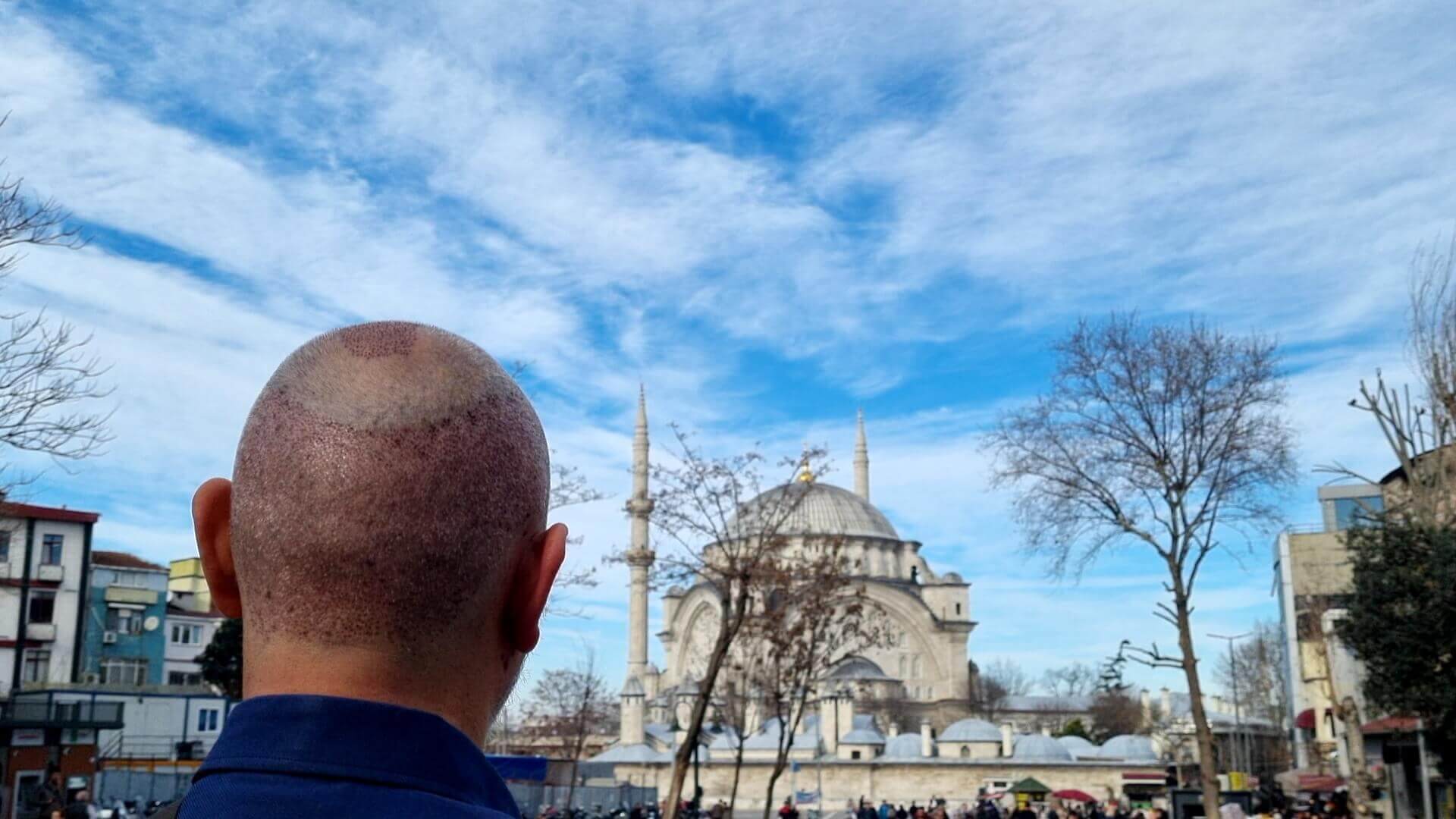 Haartransplantation in der Türkei: Sind Sie sicher, dass Sie es sich gut überlegt haben? - PROHAARKLINIK