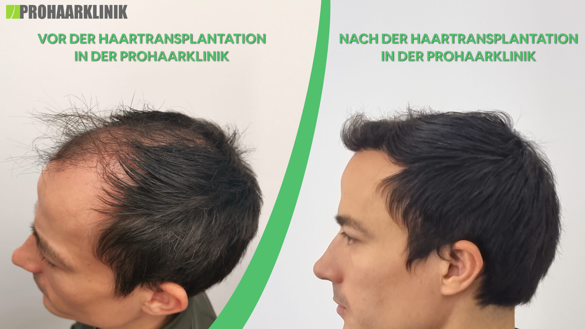 Haartransplantation vorher-nachher - PROHAARKLINIK nahe Wien