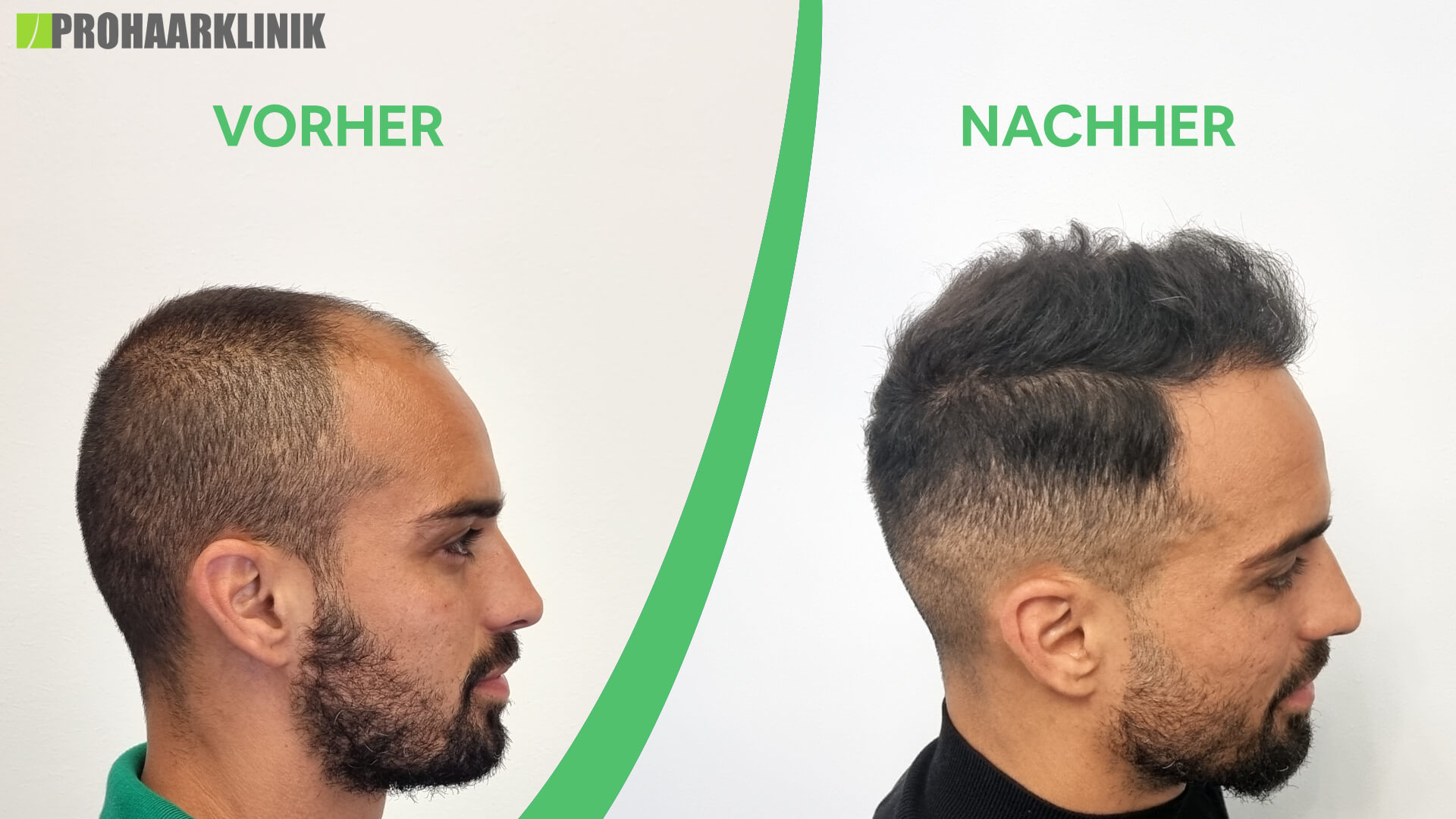 Haartransplantation vorher-nachher: Lucas - PROHAARKLINIK nahe Wien