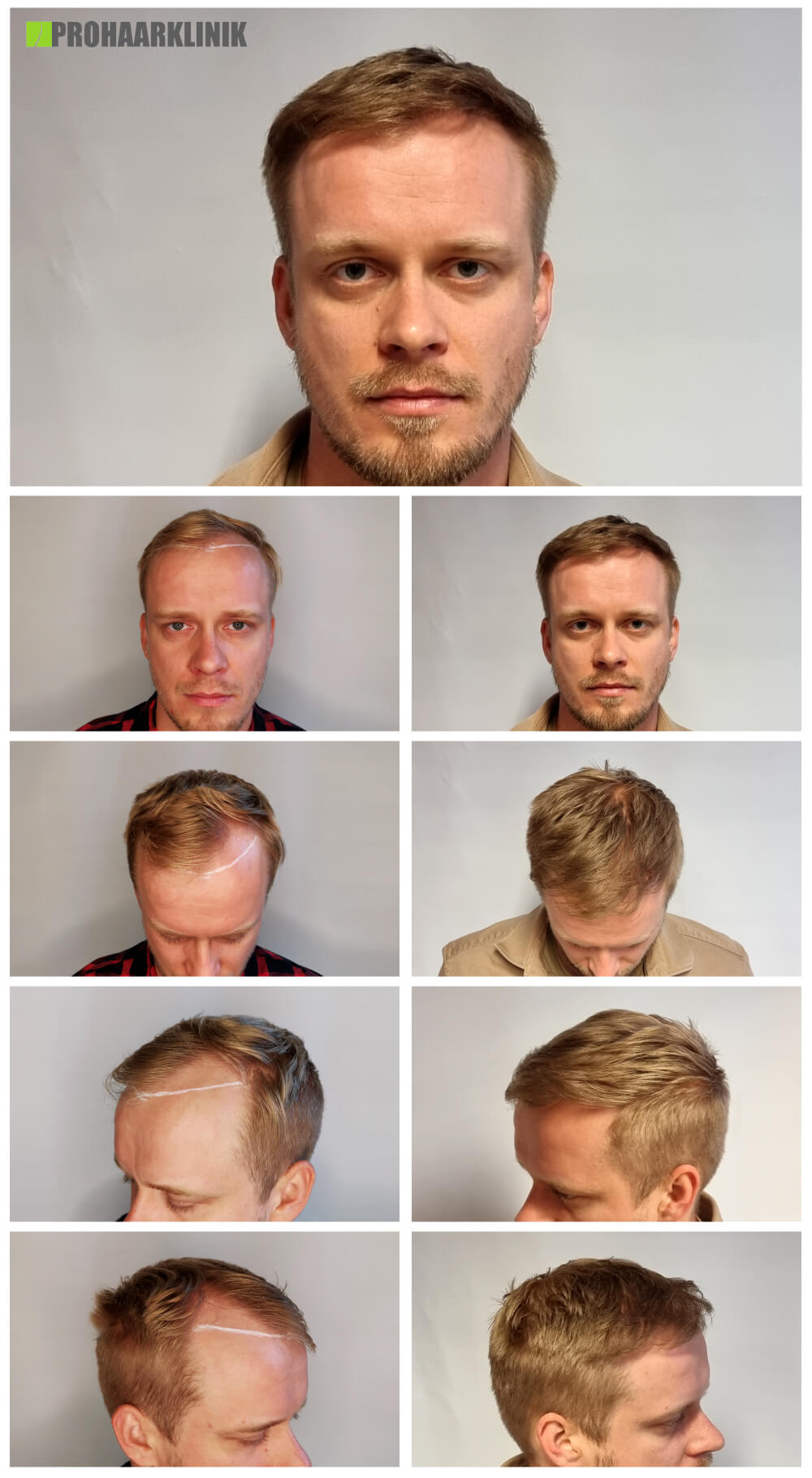 Haartransplantation vorher nachher: Peter - PROHAARKLINIK für Haartransplantation