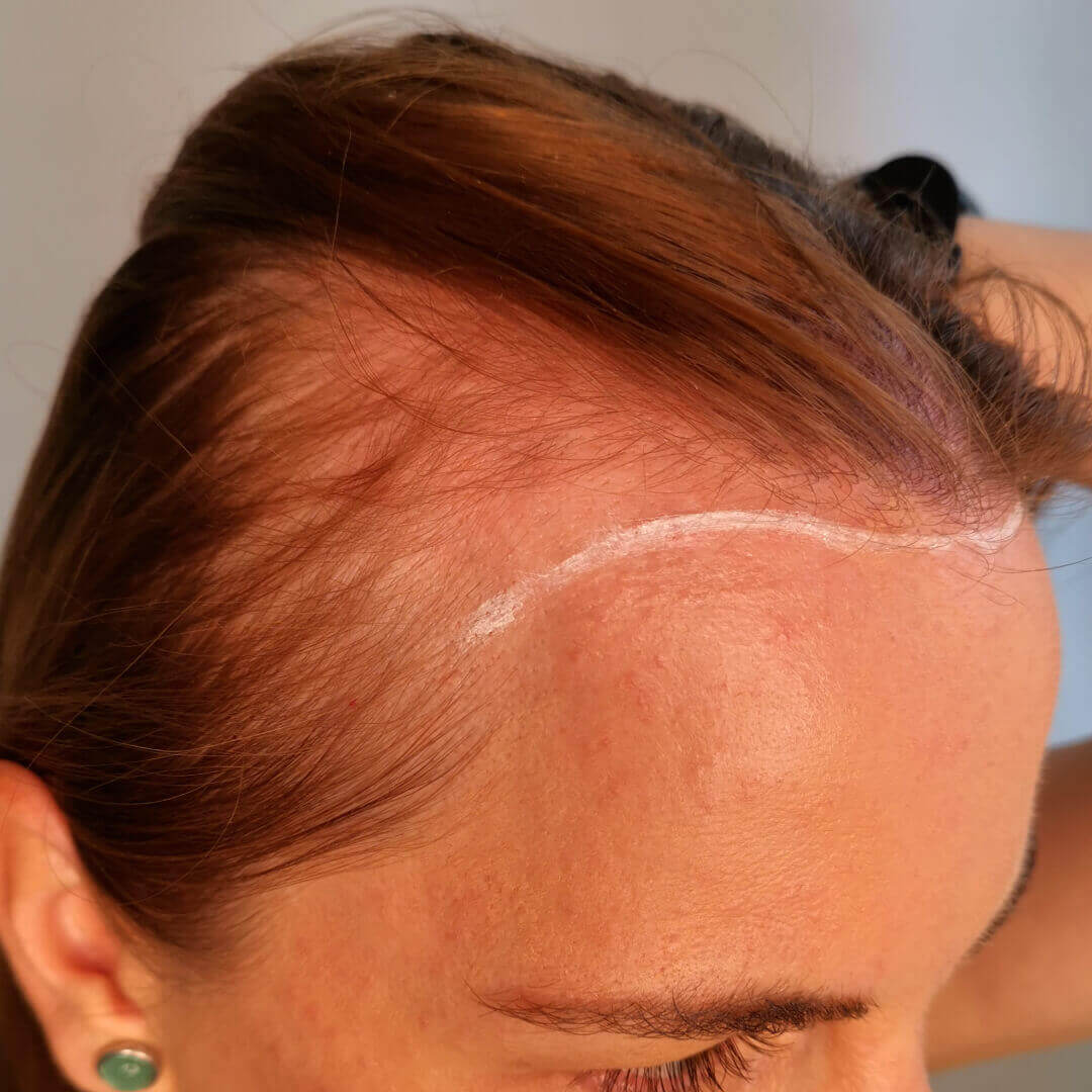 Haartransplantation vorher nachher: Ivana - PROHAARKLINIK