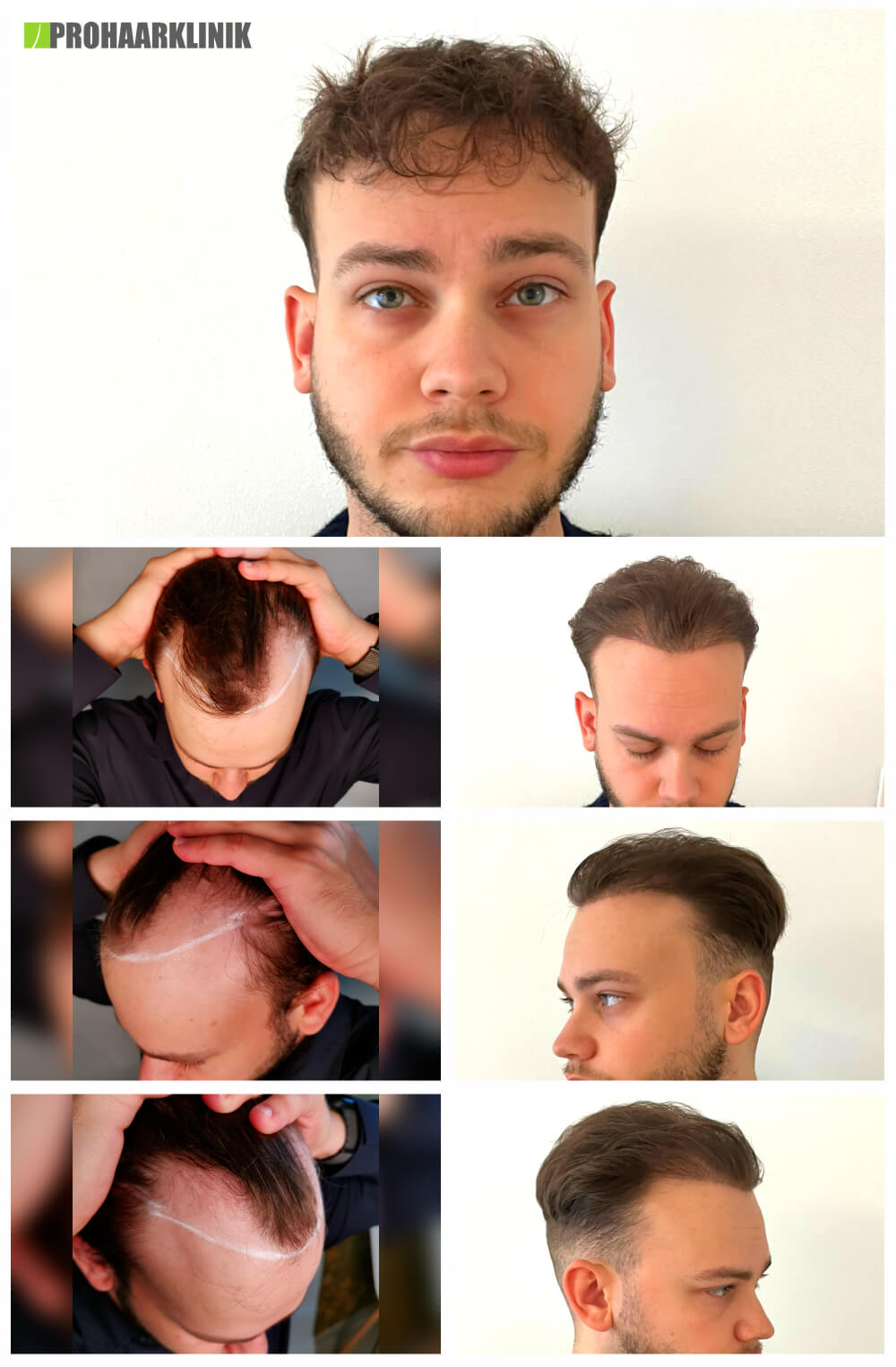 Haartransplantation Vorher Nachher