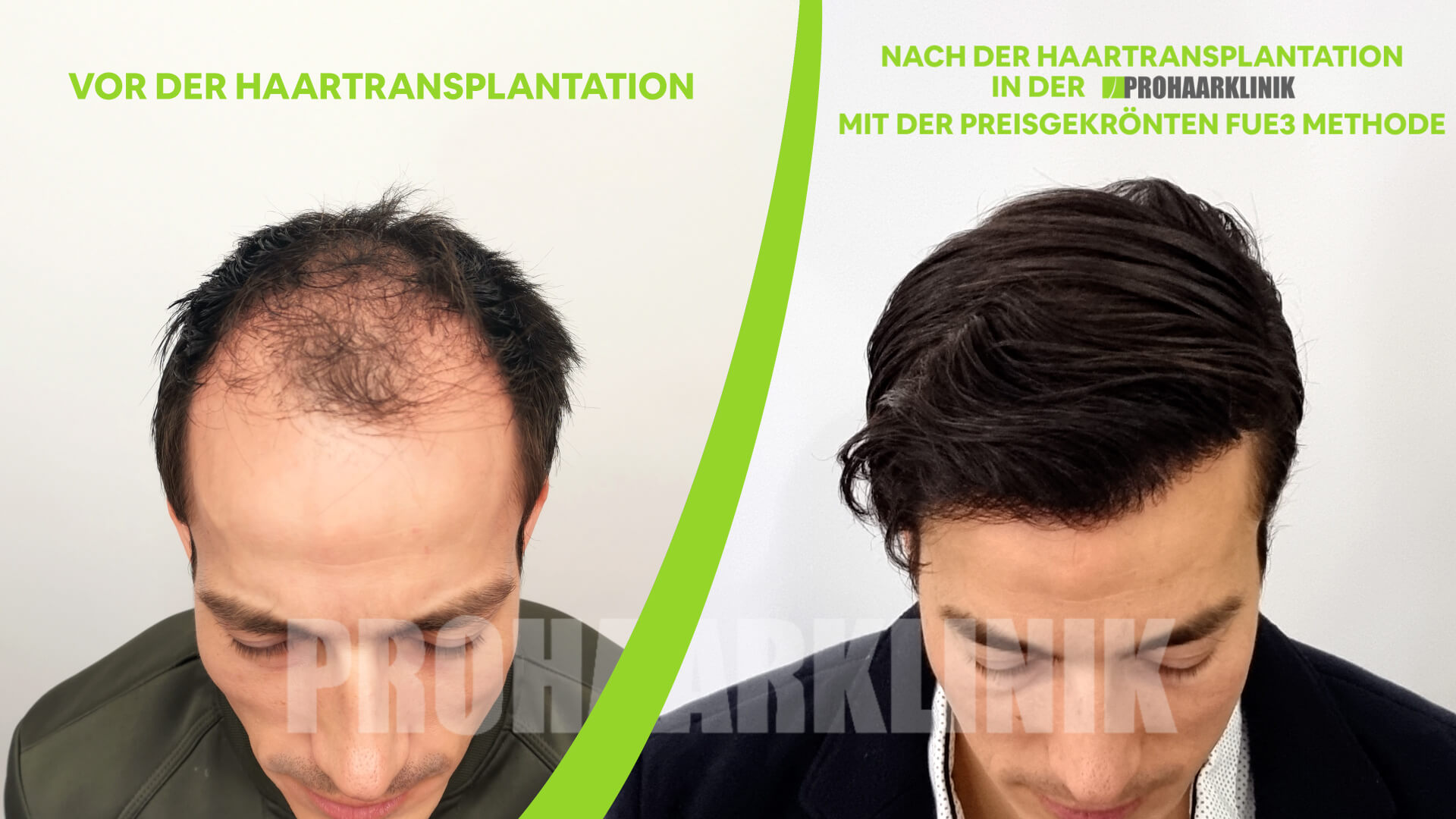 Haartransplantation vorher-nachher: Georg - PROHAARKLINIK nahe Wien