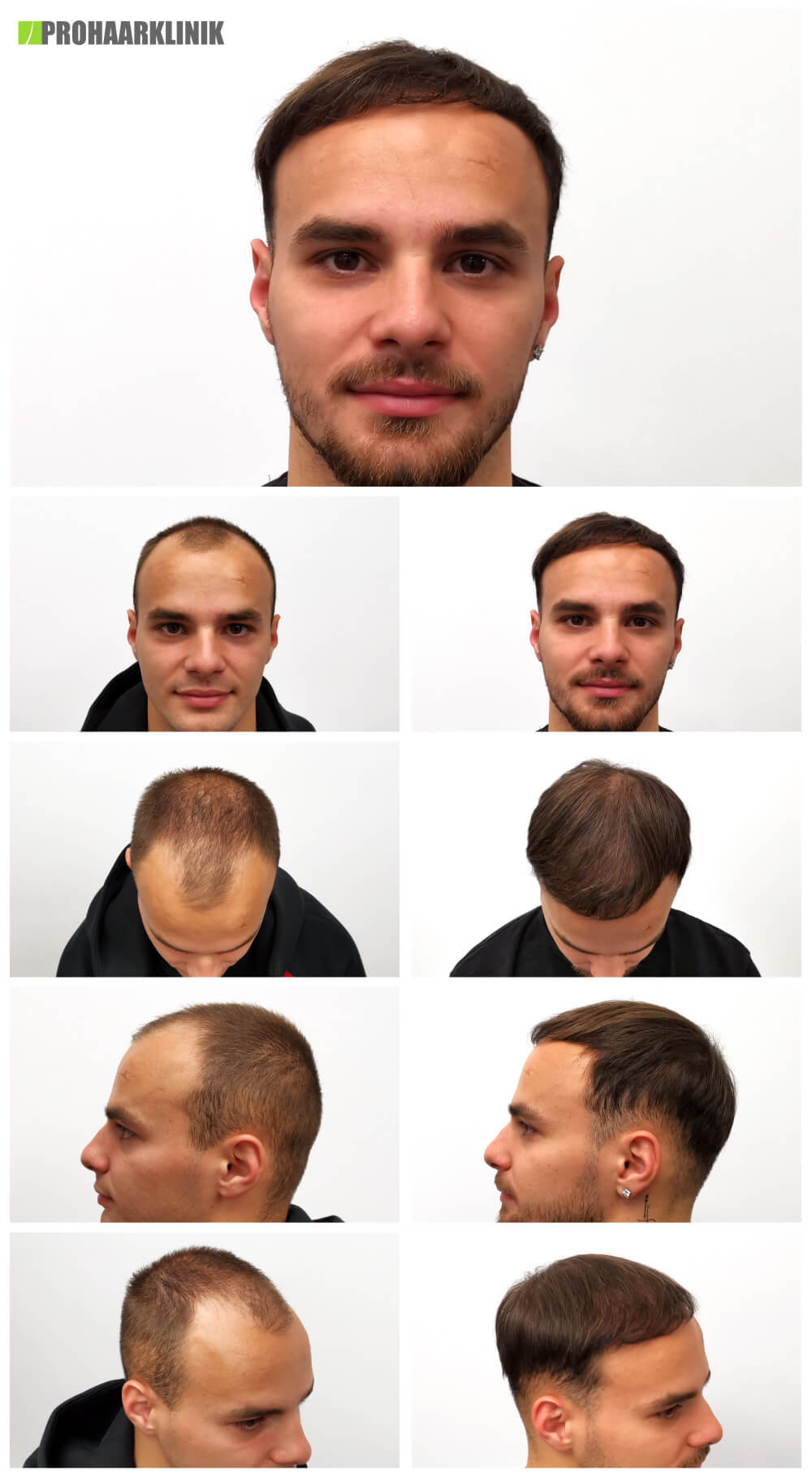 Haartransplantation vorher-nachher: Kevin - PROHAARKLINIK für Haartransplantation