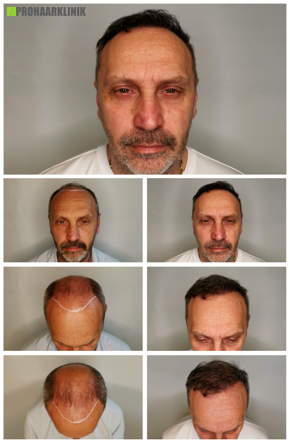 Haartransplantation vorher nachher: Robert - PROHAARKLINIK nahe Wien